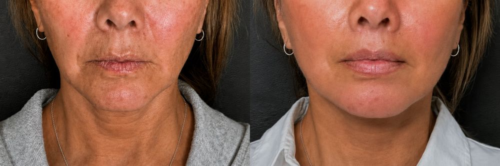 Antes y después de lifting facial sin cirugía, caso 3