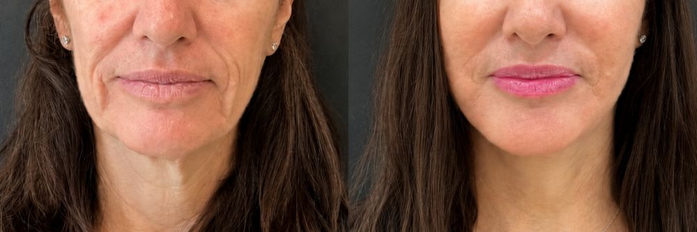 Antes y después de lifting facial sin cirugía, caso 5