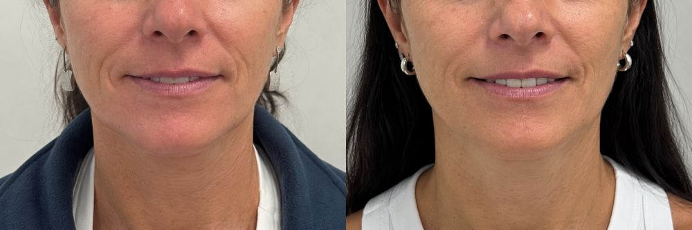 Antes y después de lifting facial sin cirugía, caso 1