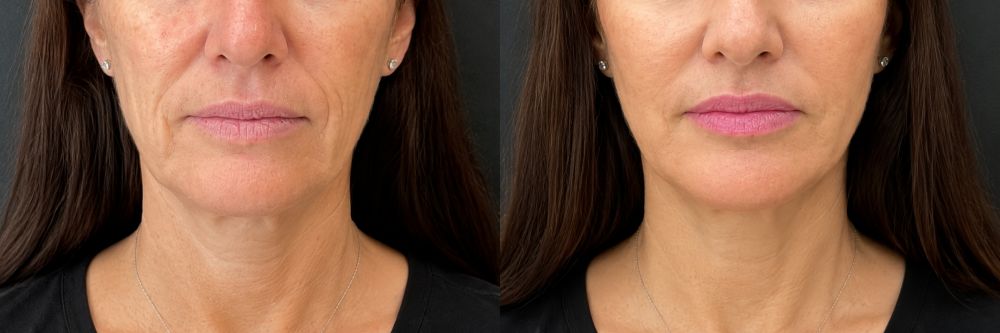 Antes y después de lifting facial sin cirugía, caso 6