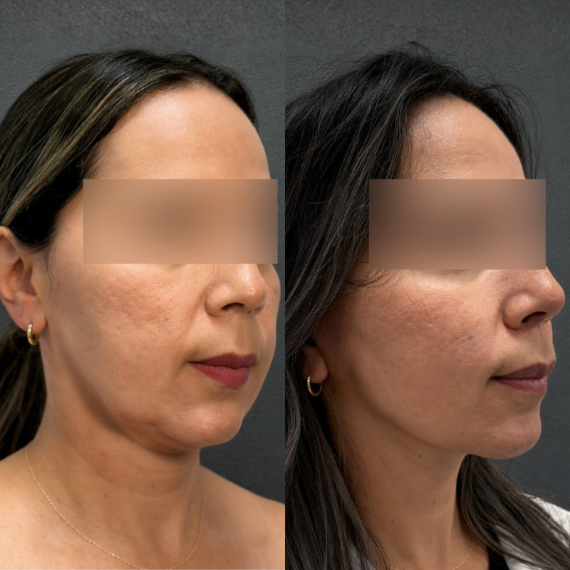 Tratamiento de lifting facial con láser en óvalo, papada y cuello en Medea Clinic