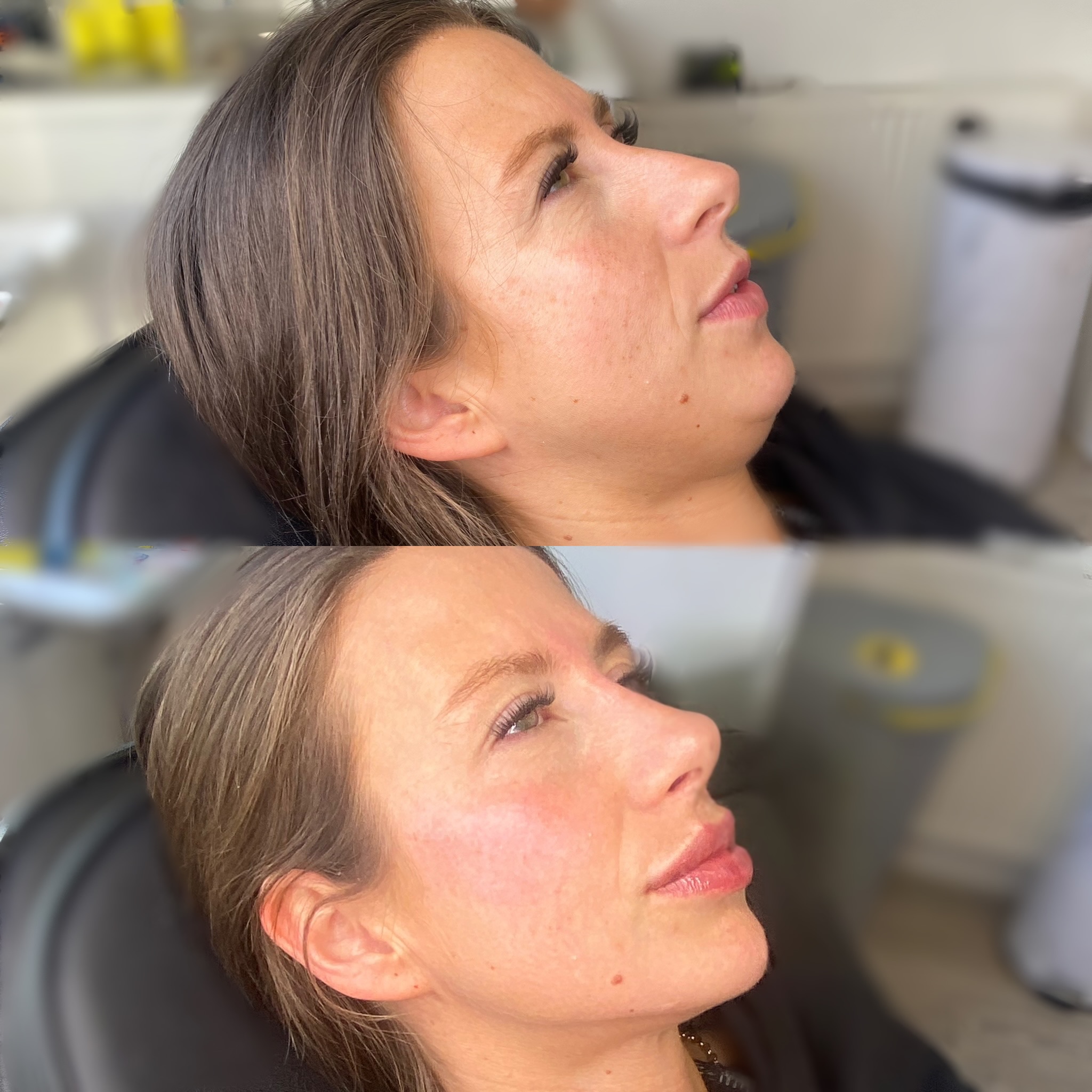 Before and after facial balancing using the Signature Sculpt Package