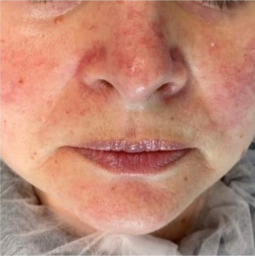 IPL photofacial before treatment — rosacea & facial redness