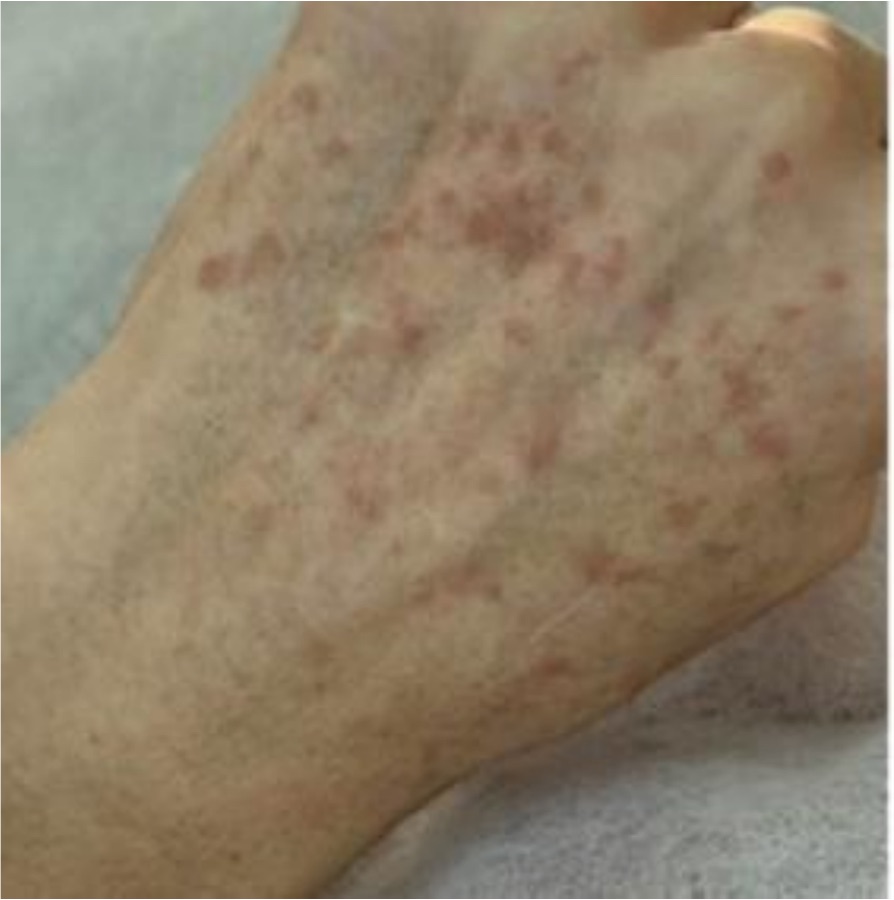 IPL photofacial before treatment — sun spots — hands