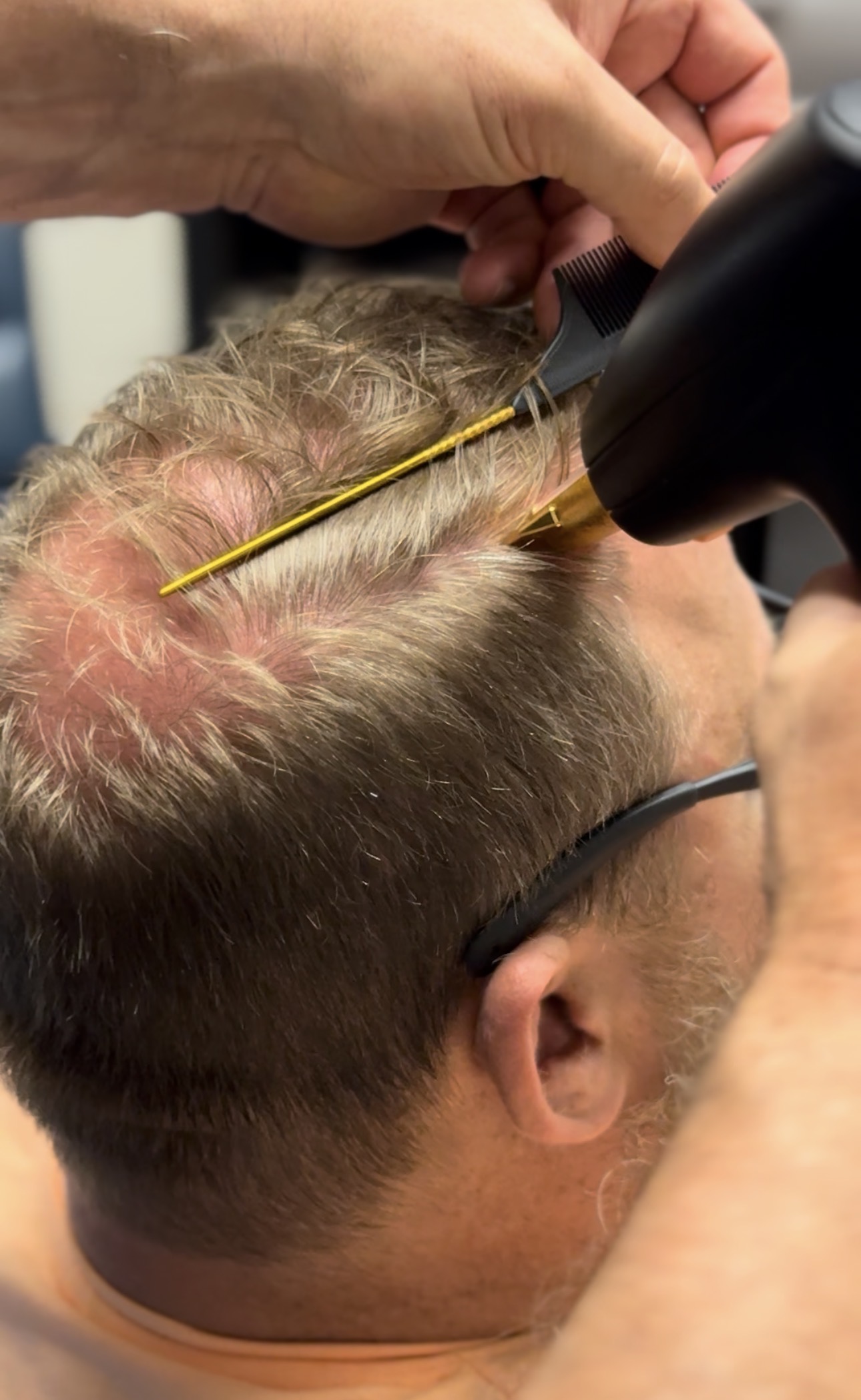 FoLix laser treatment at the follicle level
