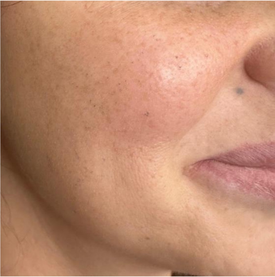 IPL photofacial after treatment — sun damage & freckles — face