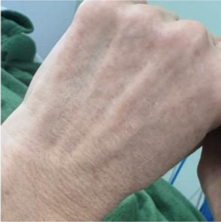 IPL photofacial after treatment — sun spots — hands