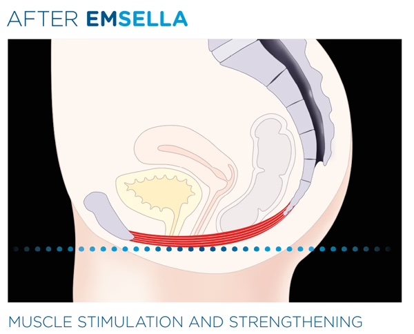 After Emsella