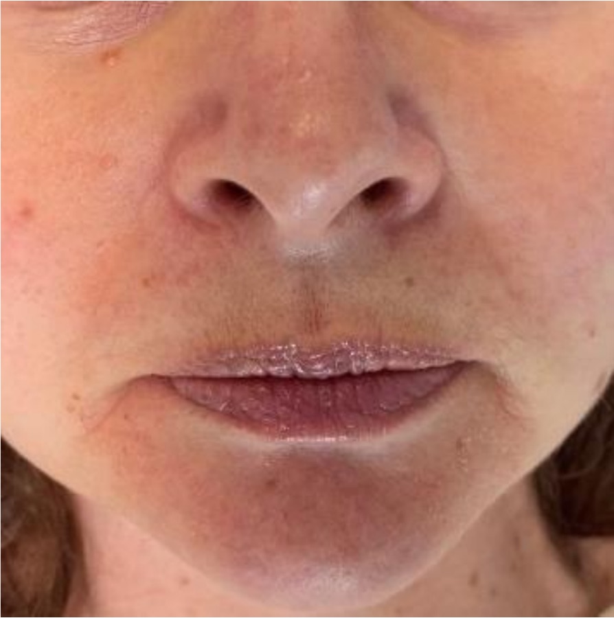 IPL photofacial after treatment — rosacea & facial redness