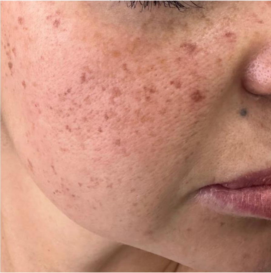 IPL photofacial before treatment — sun damage & freckles — face