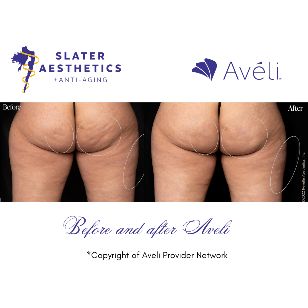 Aveli Before and After 3