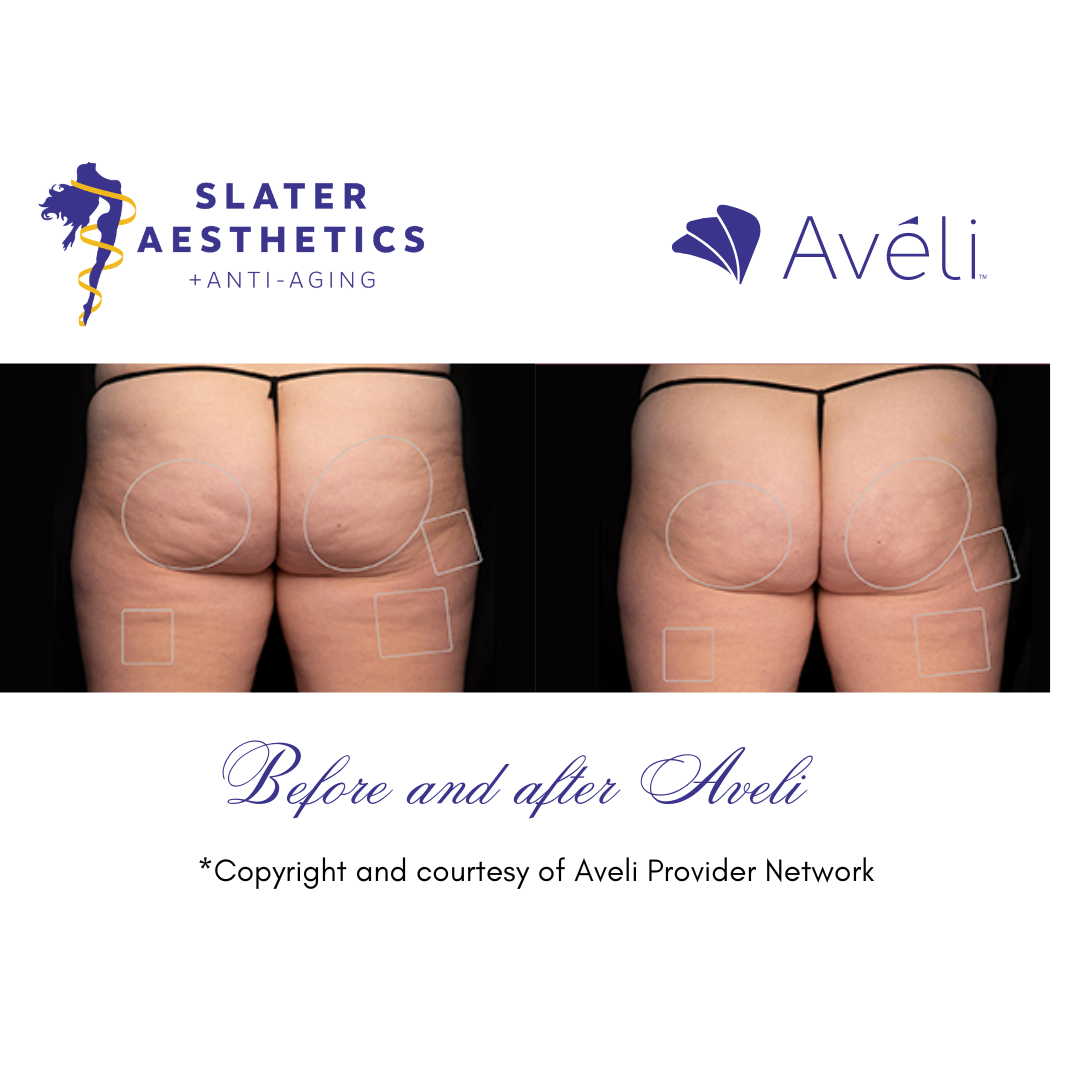 Aveli Before and After 1