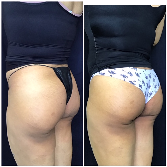 Sculptra butt lift before and after side profile view at Slater Aesthetics anti-aging clinic Georgia showing improved buttock curve and projection