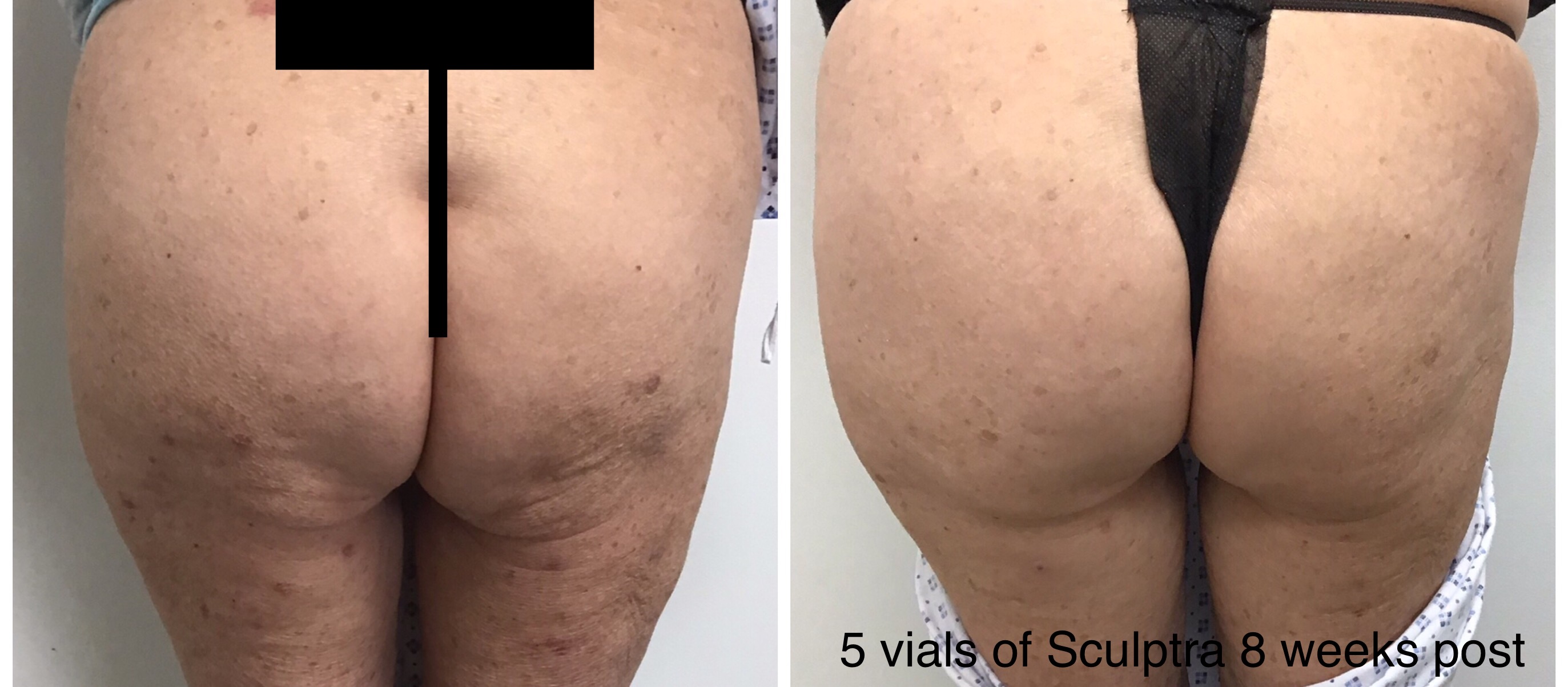 Before and after 5 vials of Sculptra butt lift treatment at Slater Aesthetics med spa Atlanta GA showing significant buttock volume enhancement 8 weeks post treatment