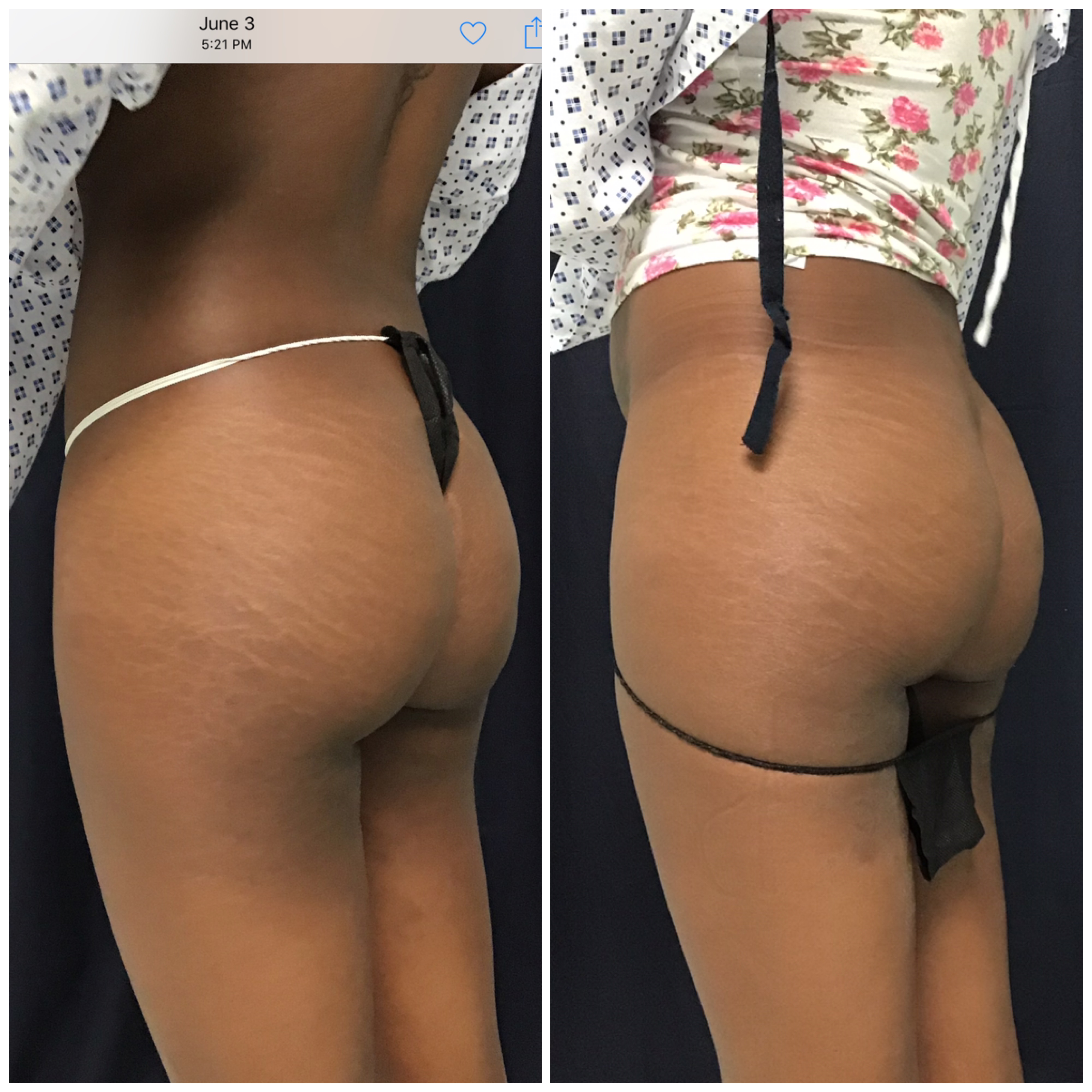 Before and after Sculptra three quarter back view results at Slater Aesthetics Warner Robins GA showing buttock volume and hip enhancement
