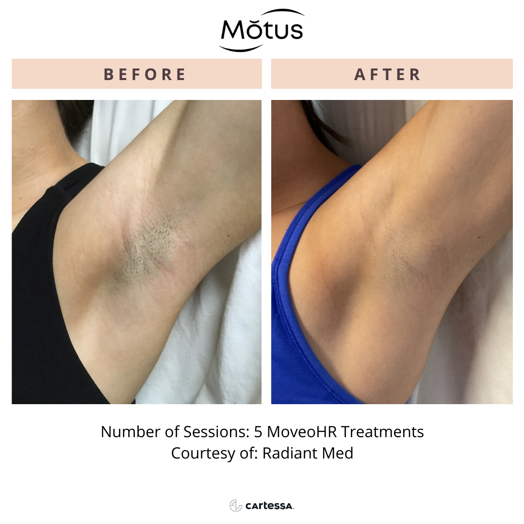 MOTUS AZ+ MoveoHR comfortable laser hair removal before and after results