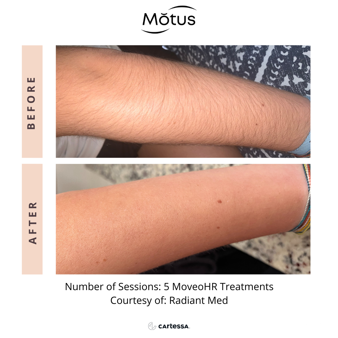 MOTUS AZ+ MoveoHR laser hair removal before and after — 5 treatments, courtesy of Radiant Med