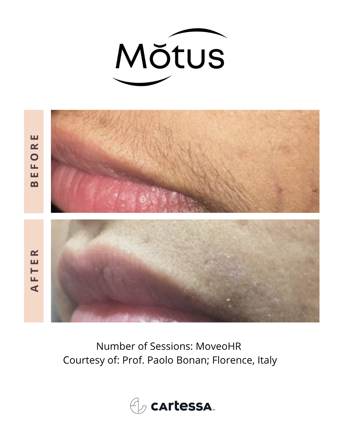 MOTUS AZ+ MoveoHR laser hair removal before and after, courtesy of Prof. Paolo Bonan Florence Italy