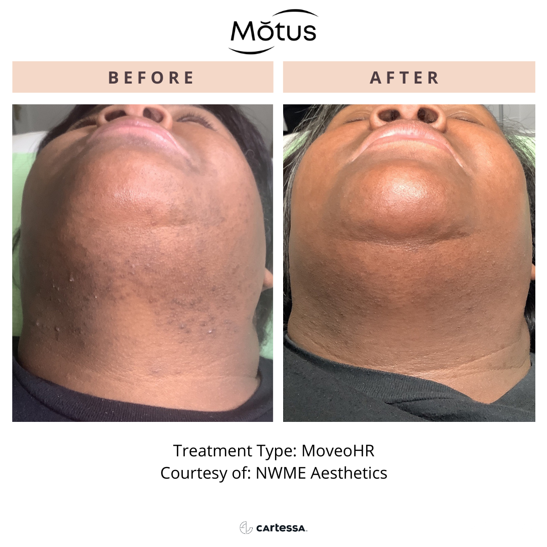 MOTUS AZ+ MoveoHR laser hair removal before and after, courtesy of NWME Aesthetics
