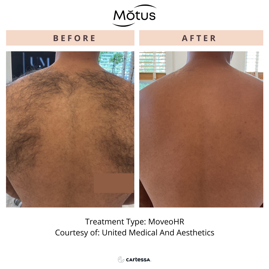 MOTUS AZ+ MoveoHR laser hair removal before and after, courtesy of United Medical And Aesthetics
