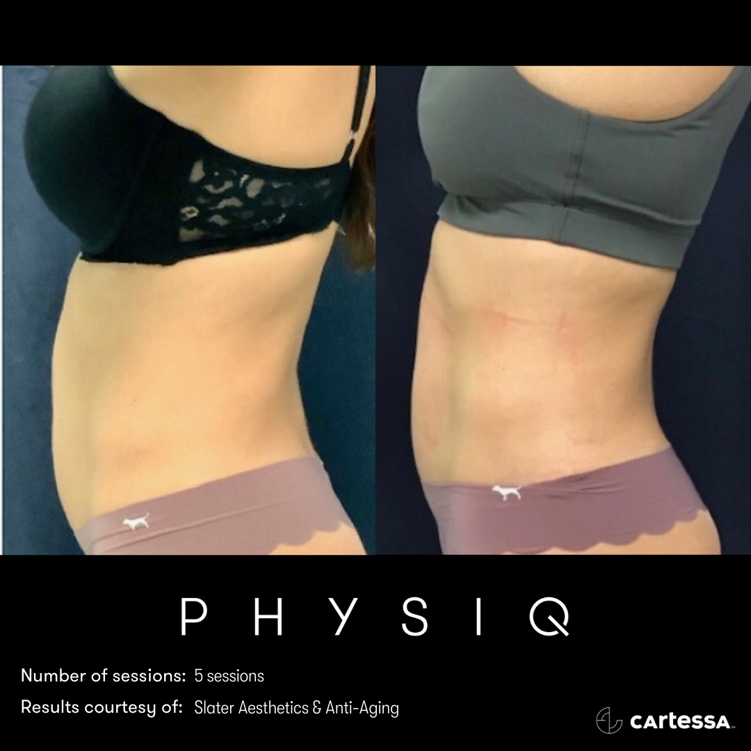 PHYSIQ body contouring before and after abdominal sculpting by Dr. Monte Slater