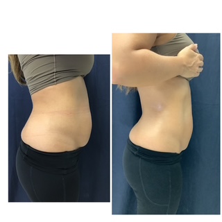 Before and after abdominal and waistline body contouring side profile at Slater Aesthetics med spa Atlanta GA