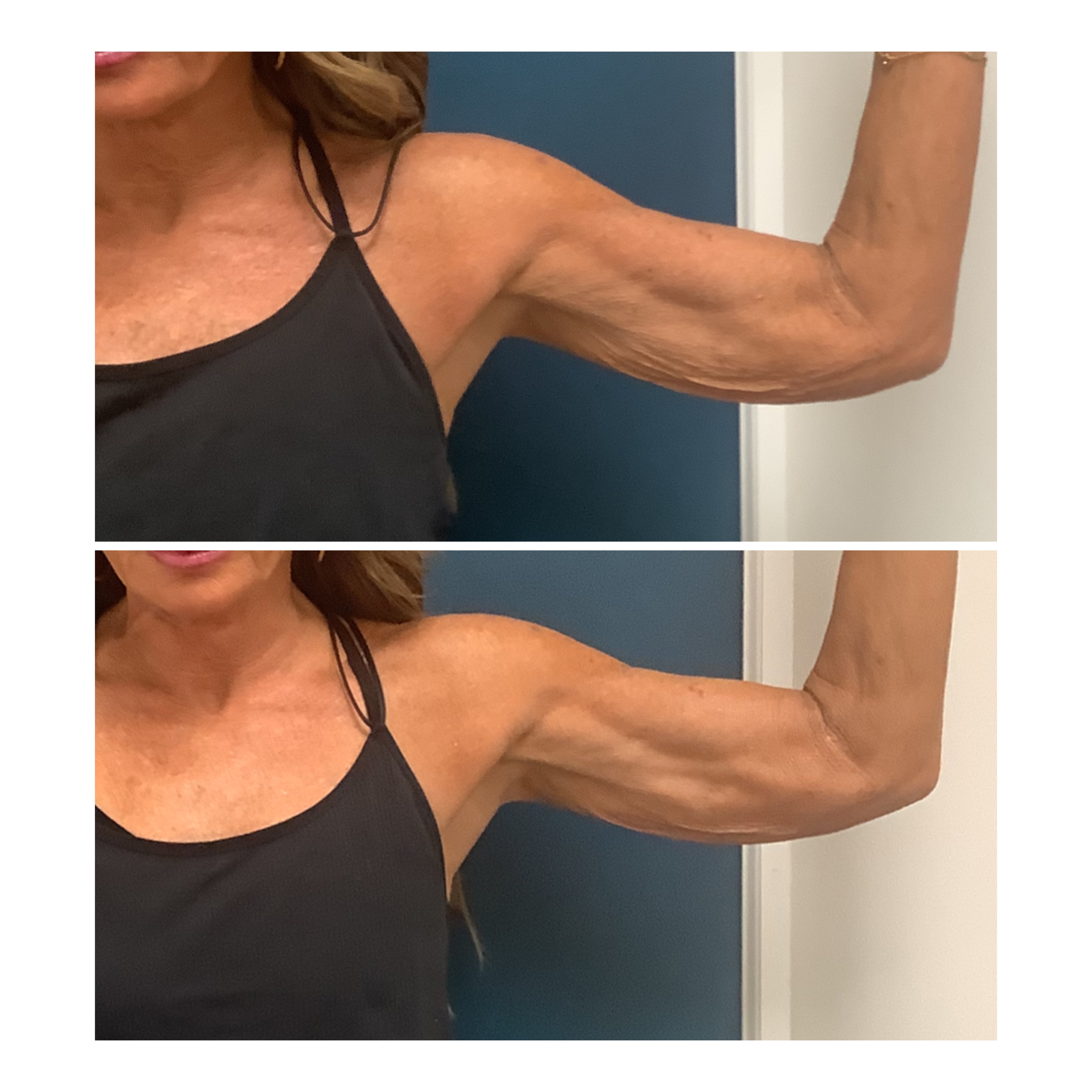 Before and after upper arm tightening and contouring at Slater Aesthetics Atlanta and Warner Robins GA