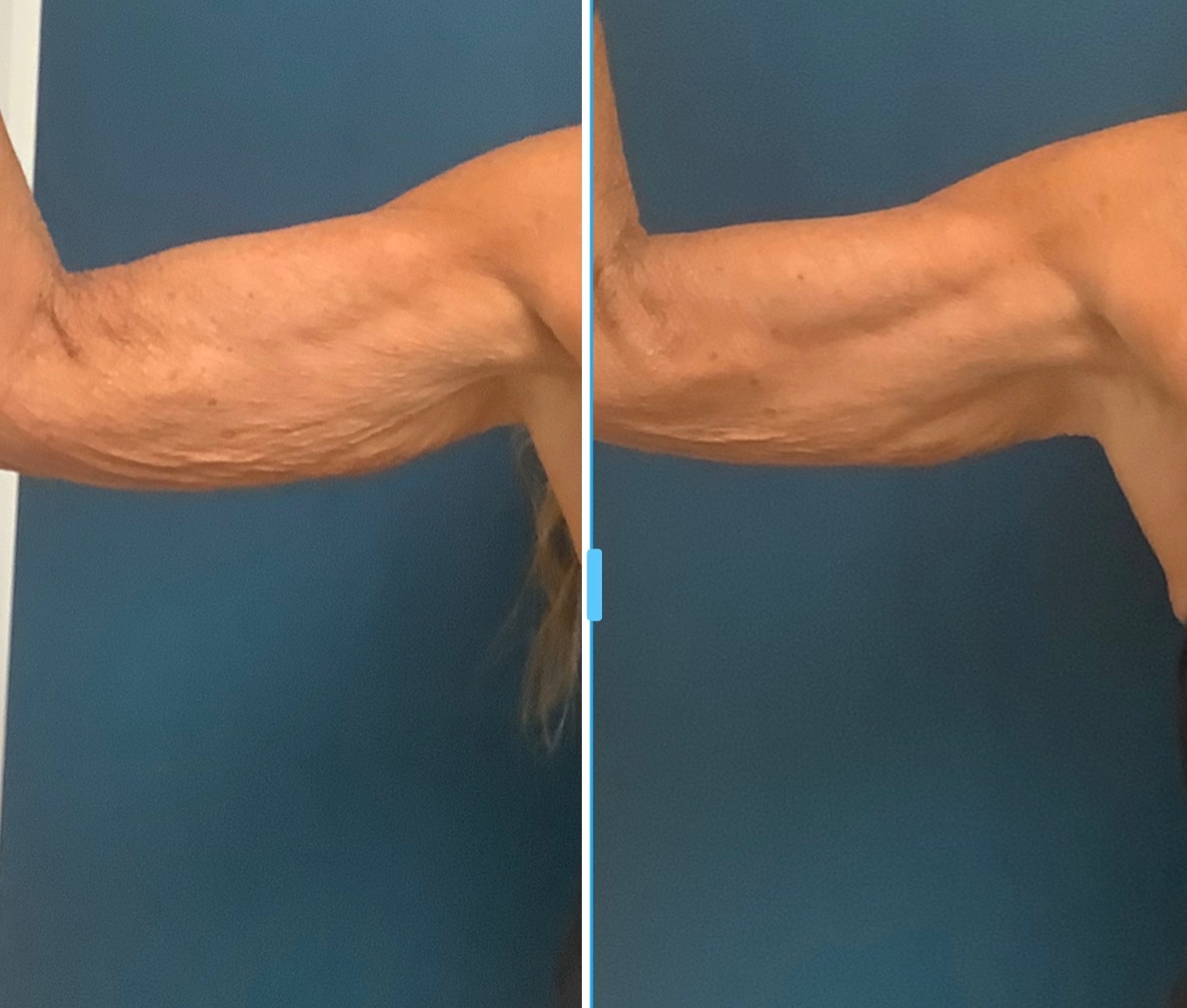 Before and after waistline and flank body contouring results at Slater Aesthetics