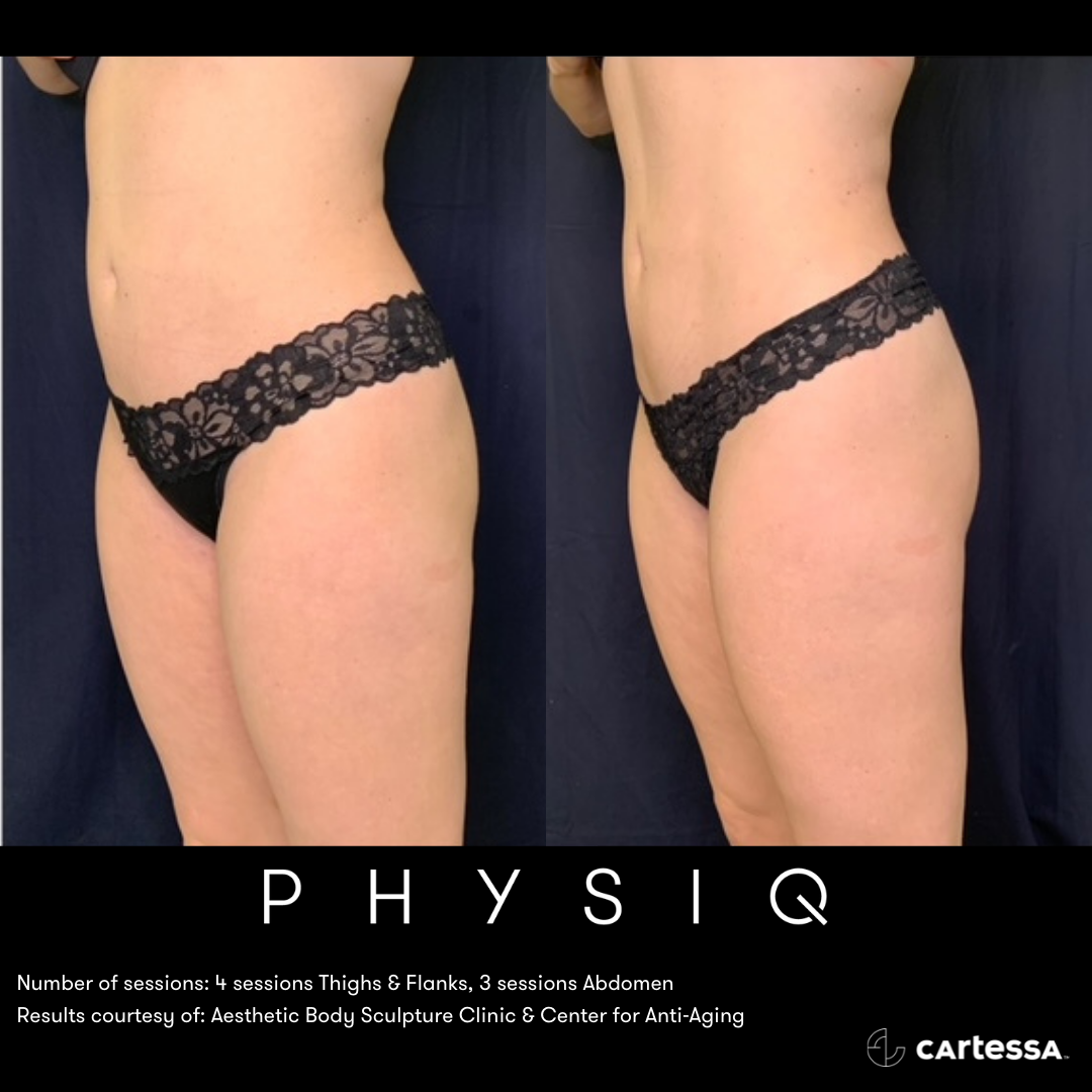 PHYSIQ core toning and abdomen tightening before and after results by Dr. Slater