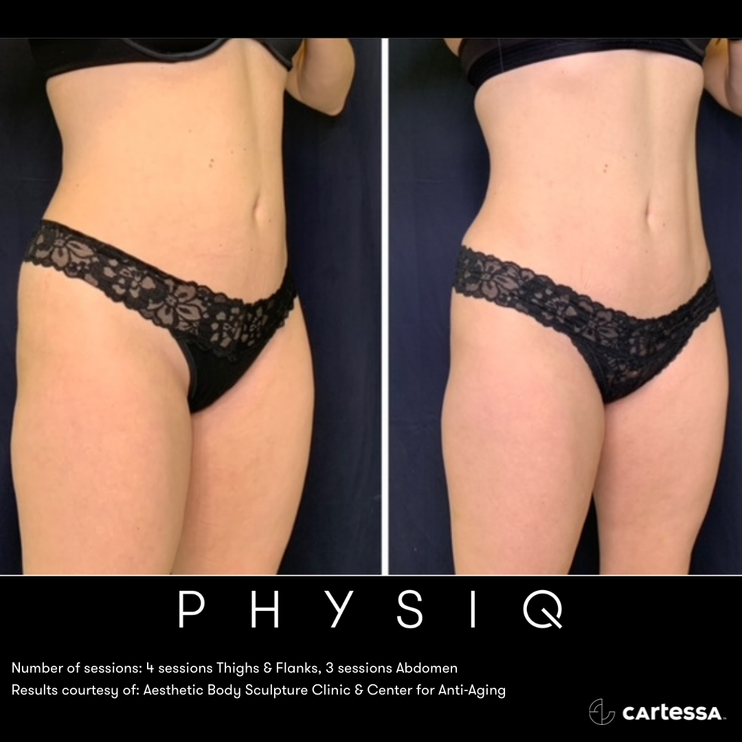 PHYSIQ abdominal smoothing and silhouette refinement results at Slater Aesthetics