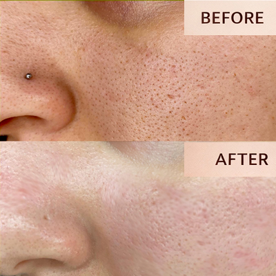 Facial Before After