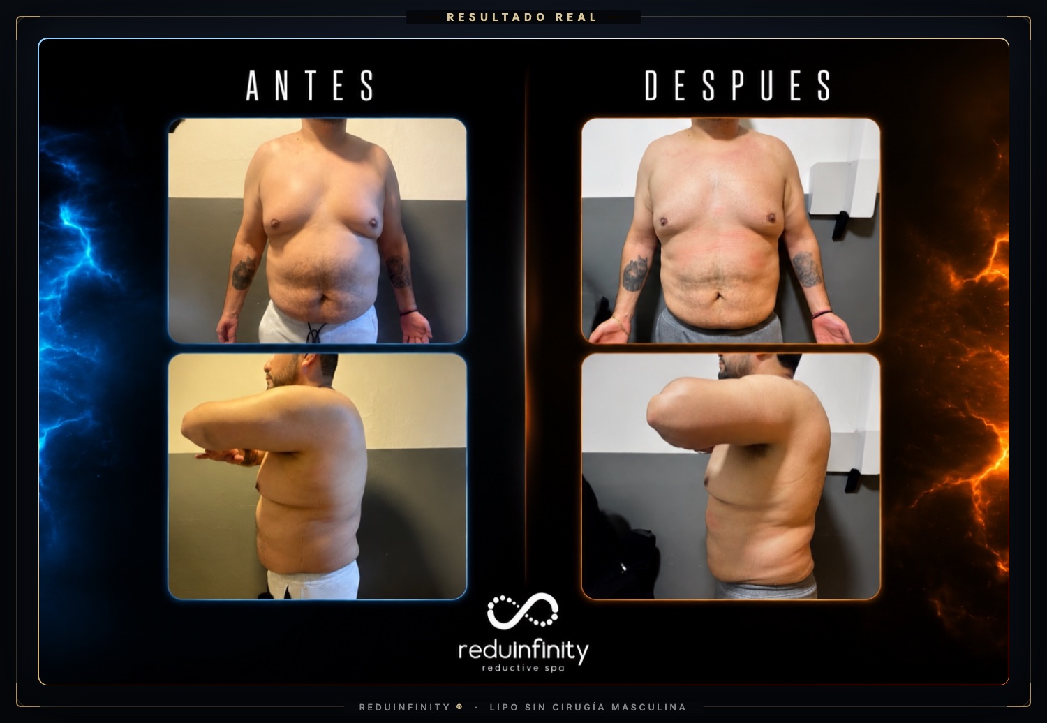 Antes y después real de un cliente de Reduinfinity