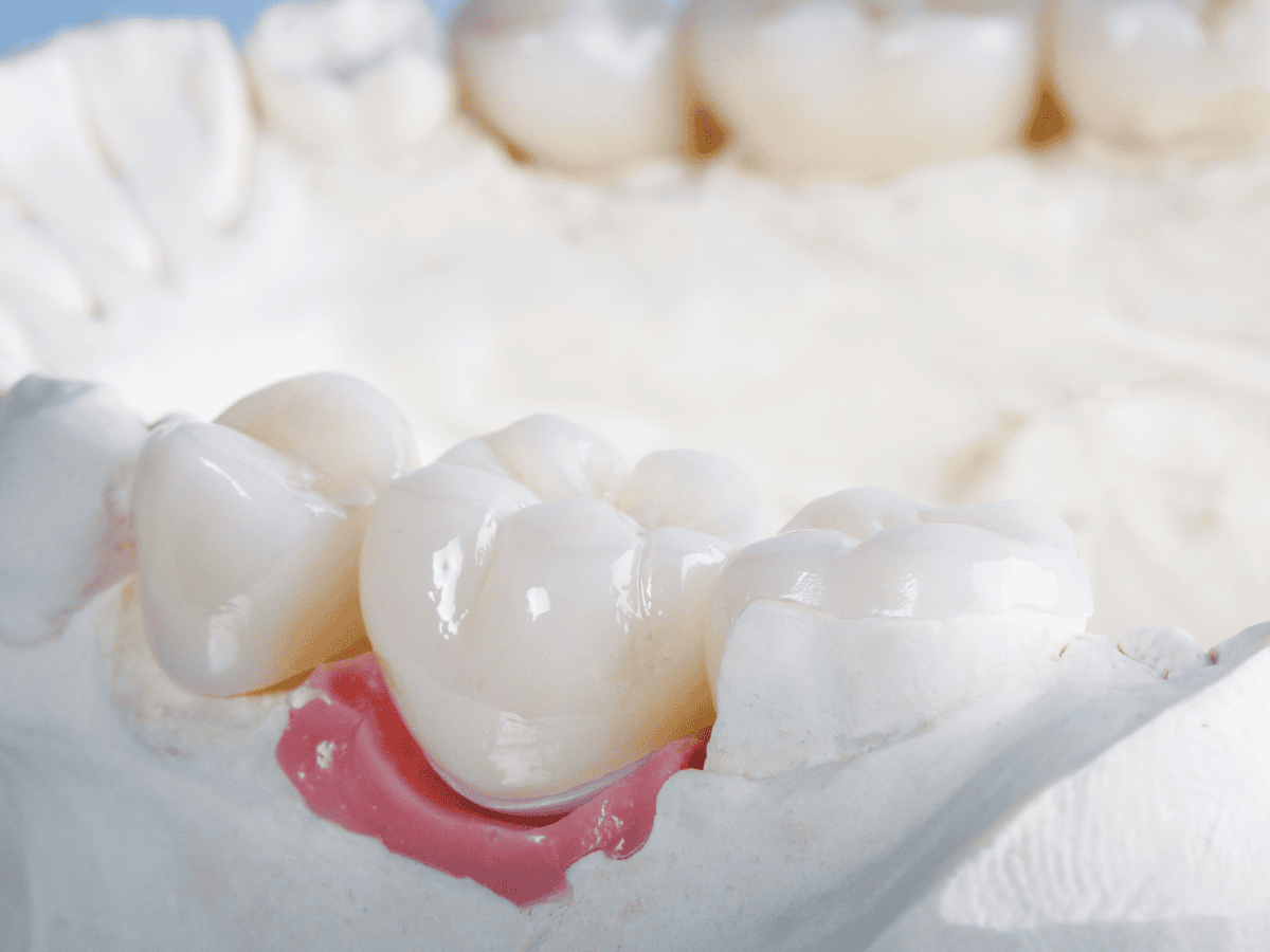 Application of bonding agent inside cleaned cavity Application of bonding agent inside cleaned cavity