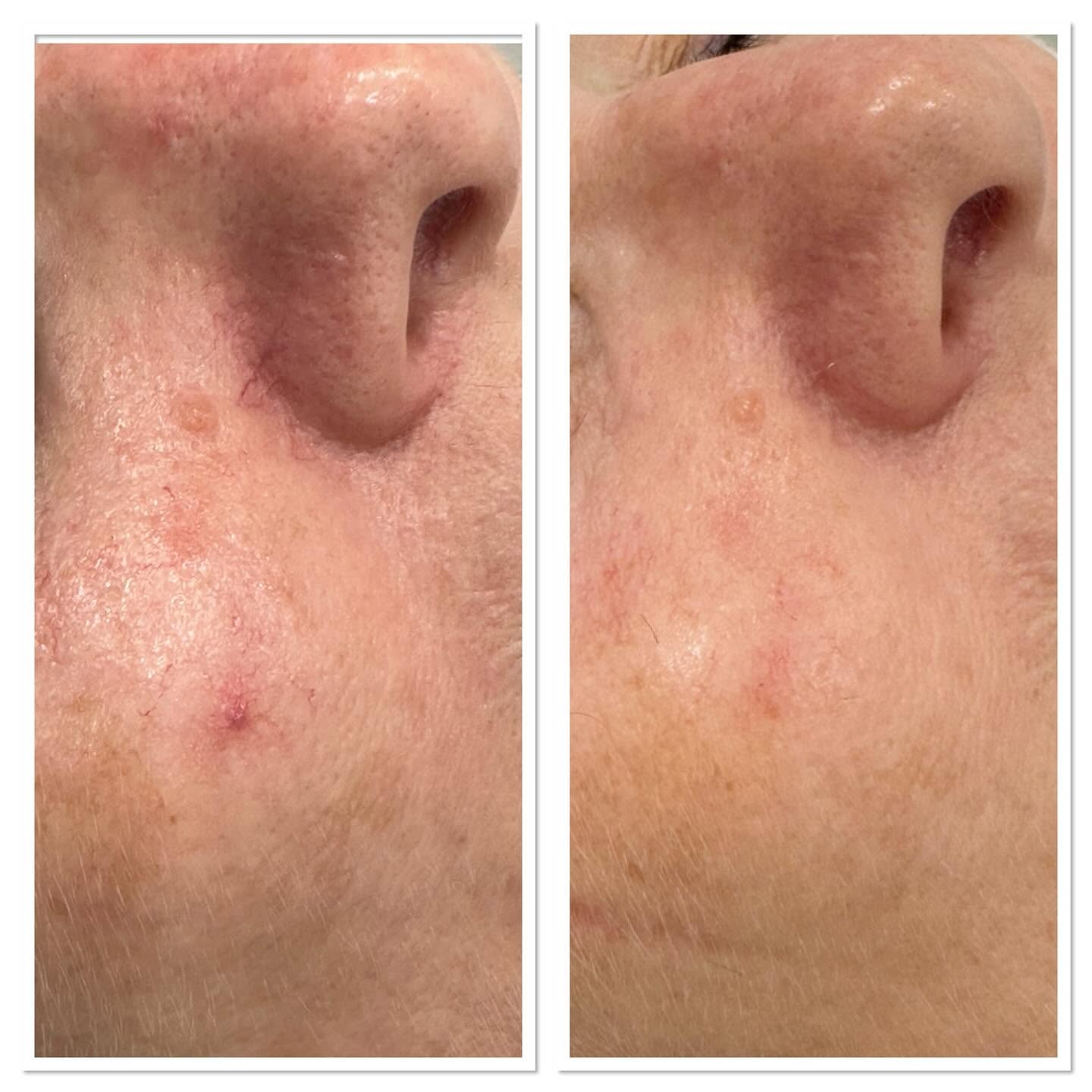 Before and after photos of a studio client treated for vascular concerns