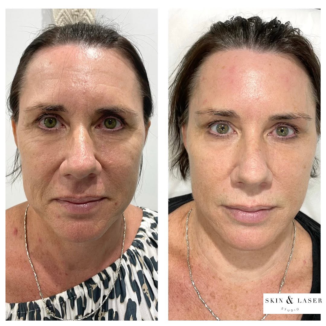 Full face rejuvenation before and after