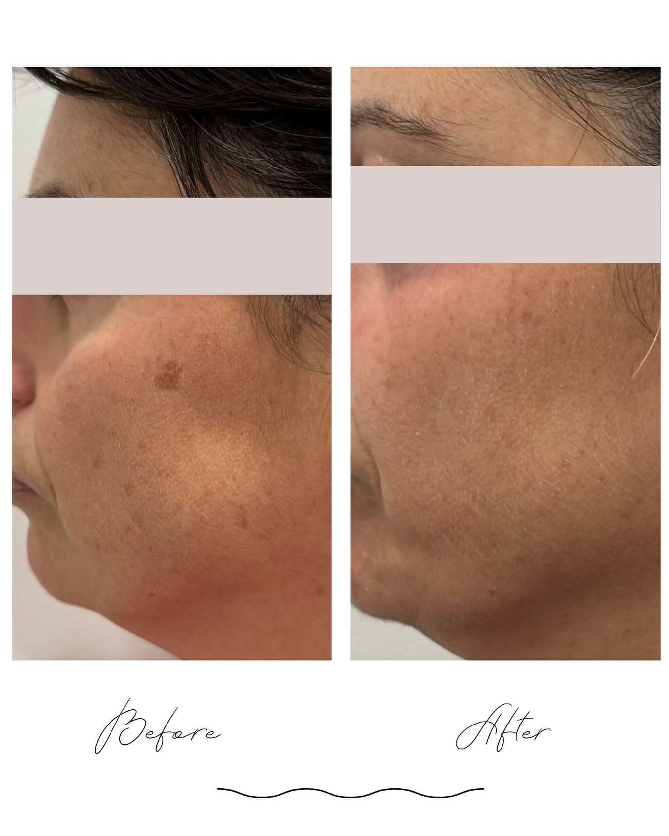 Before and after photos of a studio client treated for pigmentation