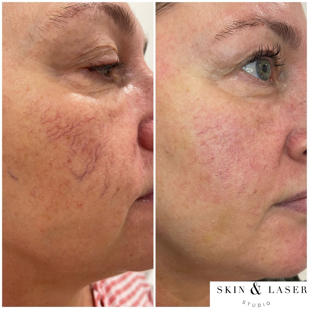 Before and after photos of a studio client treated for redness and capillaries