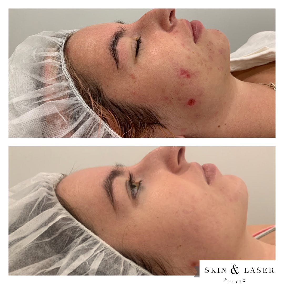 Before and after photos of a studio client treated for breakouts