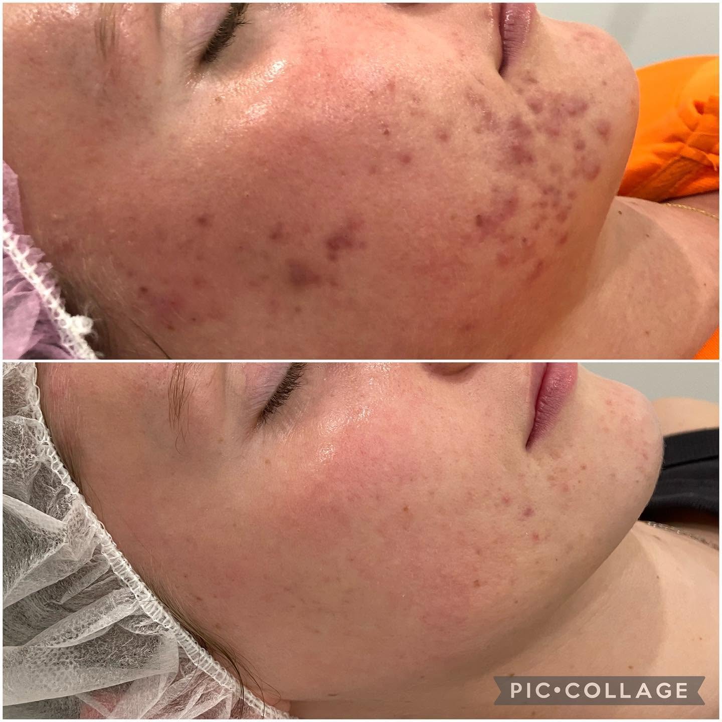 Before and after photos of a studio client treated for breakouts