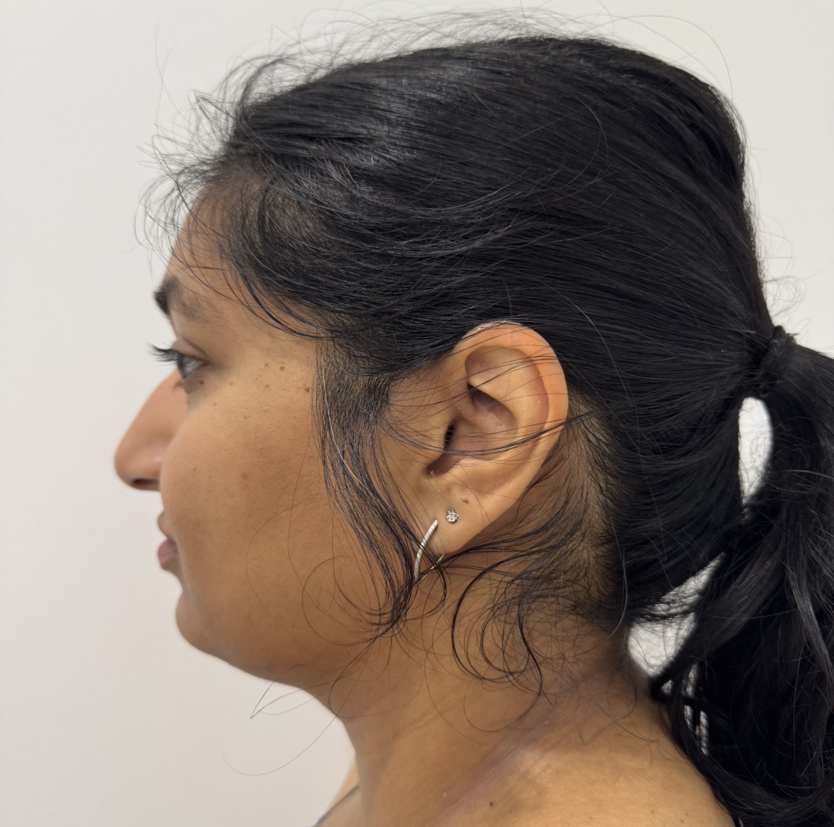Before HIFU, studio client