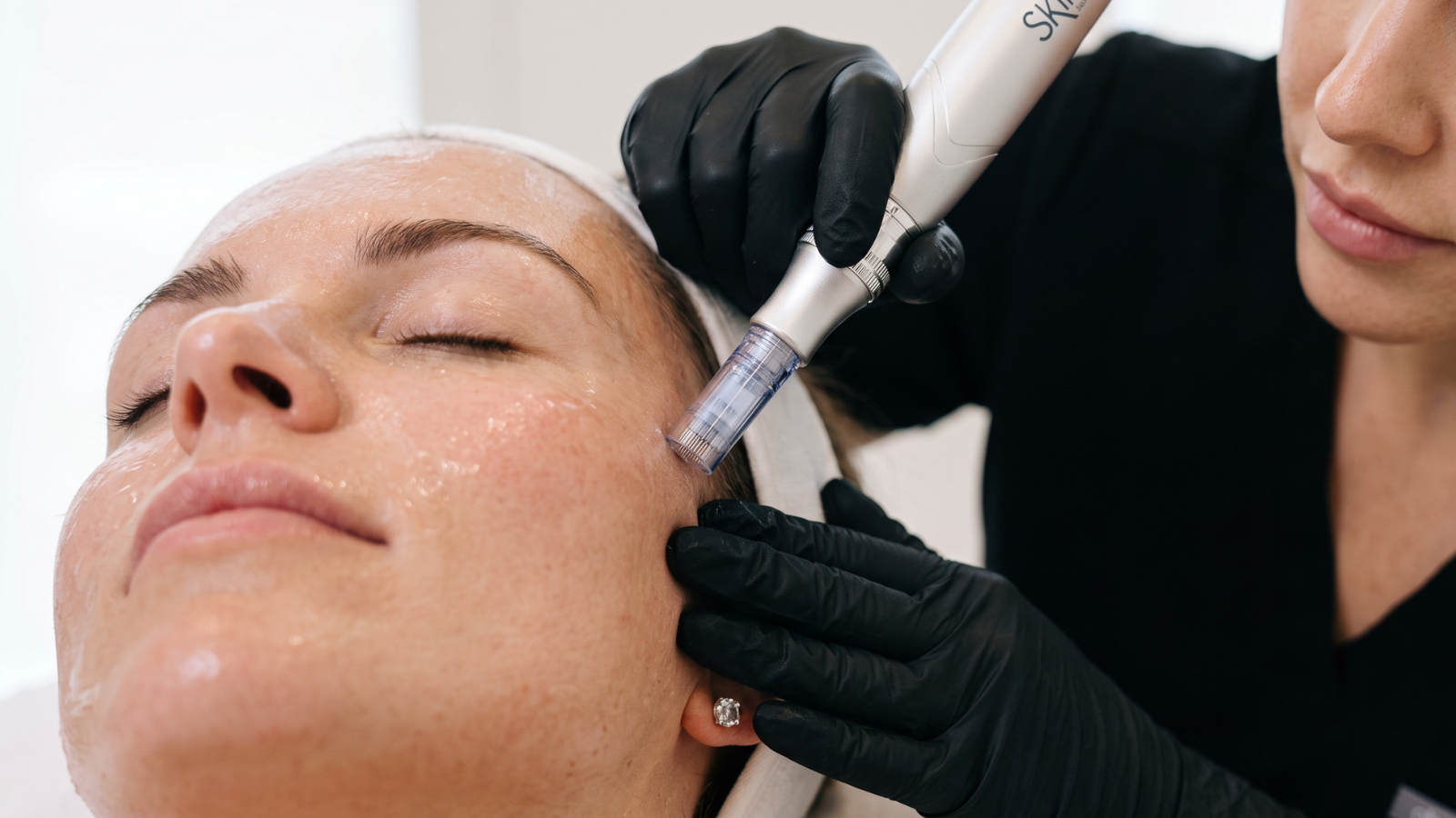 Close-up of a professional SkinPen microneedling treatment improving skin texture and collagen production. Close-up of a professional SkinPen microneedling treatment improving skin texture and collagen production.