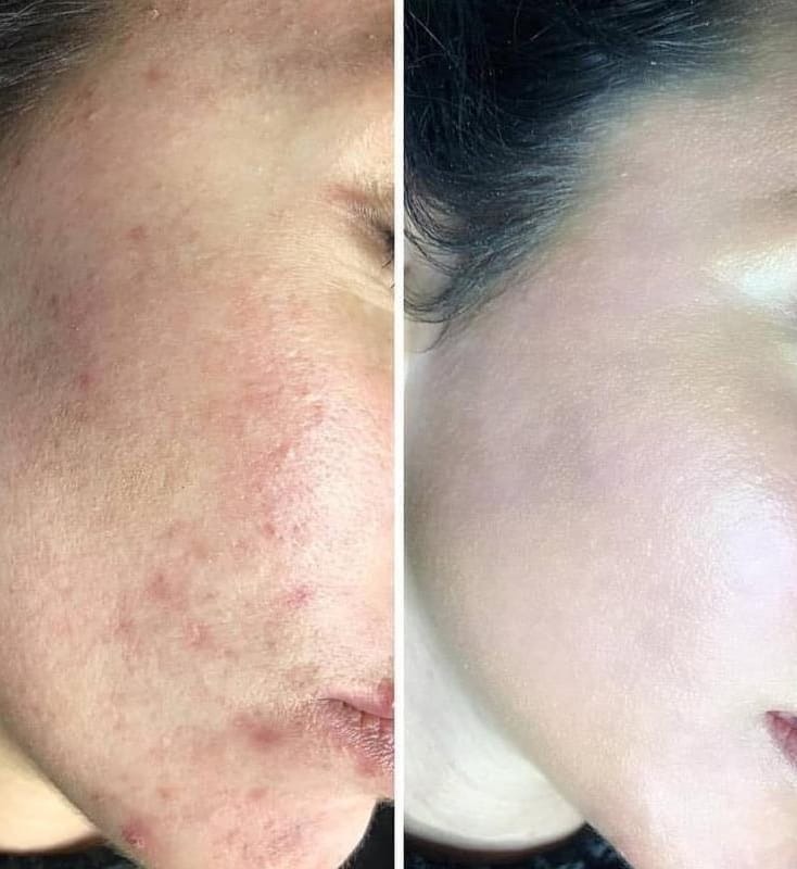 Microneedling for Acne Scars Microneedling for Acne Scars