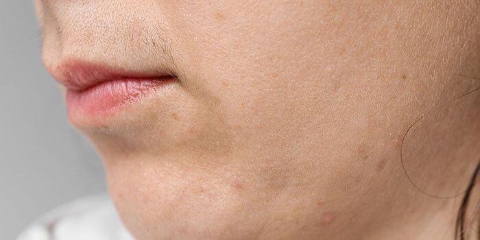Woman with unwanted chin hair considering facial hair removal in Clinton Township, MI Woman with unwanted chin hair considering facial hair removal in Clinton Township, MI