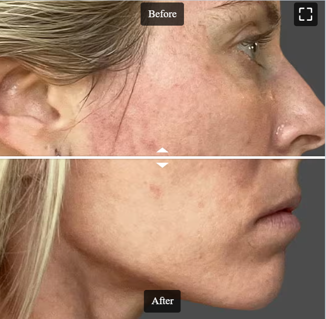 face reality skincare acne treament at treuvis med spa before and after face reality skincare acne treament at treuvis med spa before and after