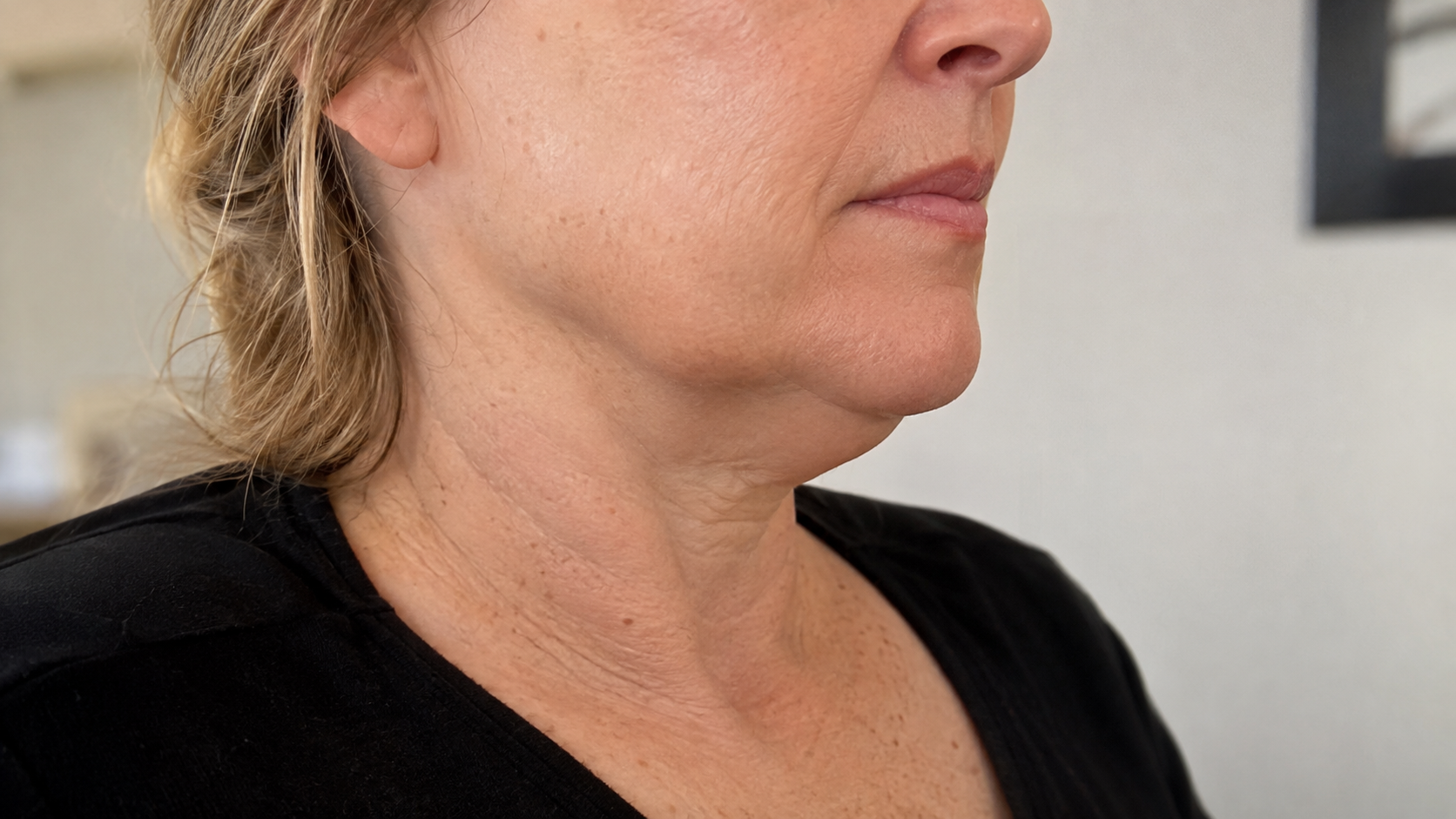 Woman in her 50s showing natural skin laxity under the chin and along the jawline Woman in her 50s showing natural skin laxity under the chin and along the jawline