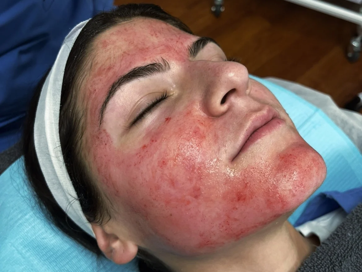 Close-up of a client's face showing redness and pinpoint marks immediately after a microneedling treatment at Treuvis Med Spa in Clinton Township, MI