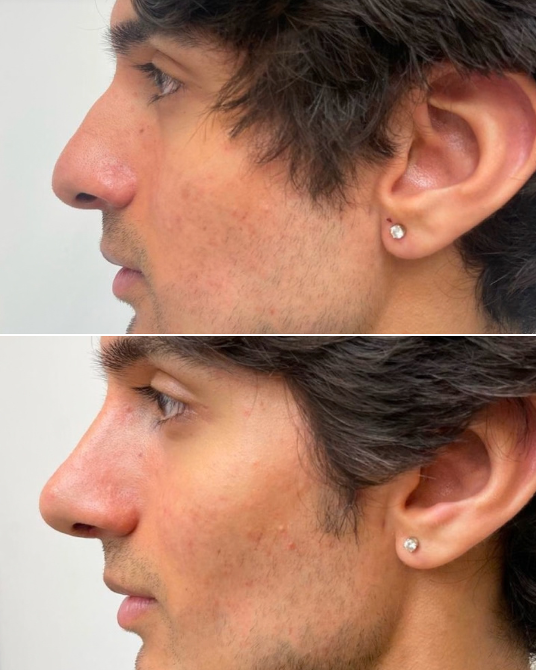 Resultado de rinoplastia, caso real, antes y después