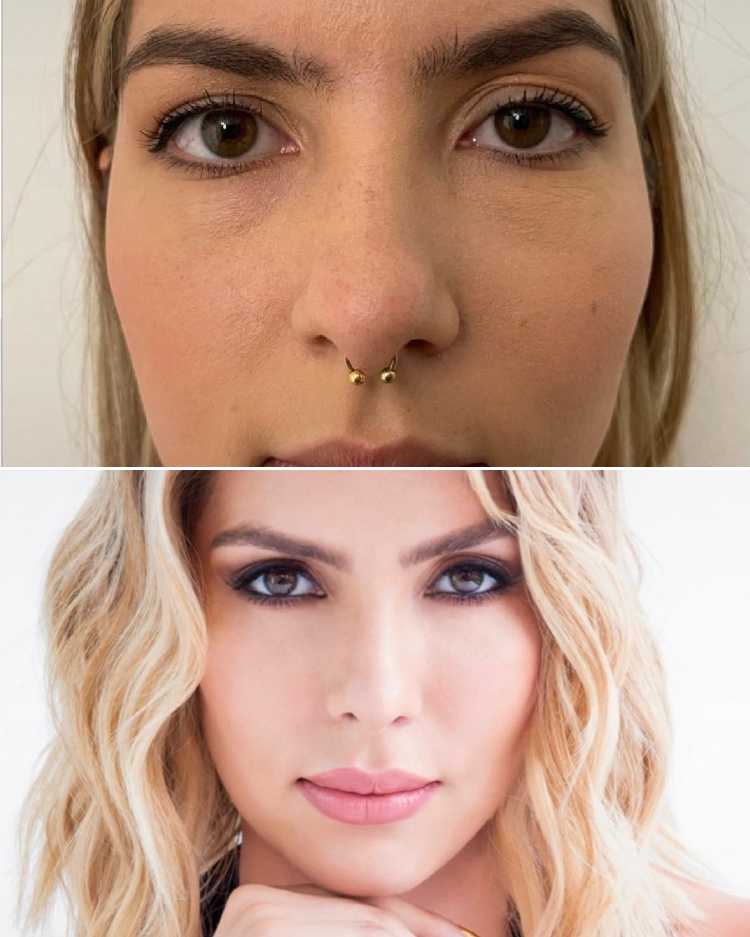 Resultado de rinoplastia, caso real, antes y después
