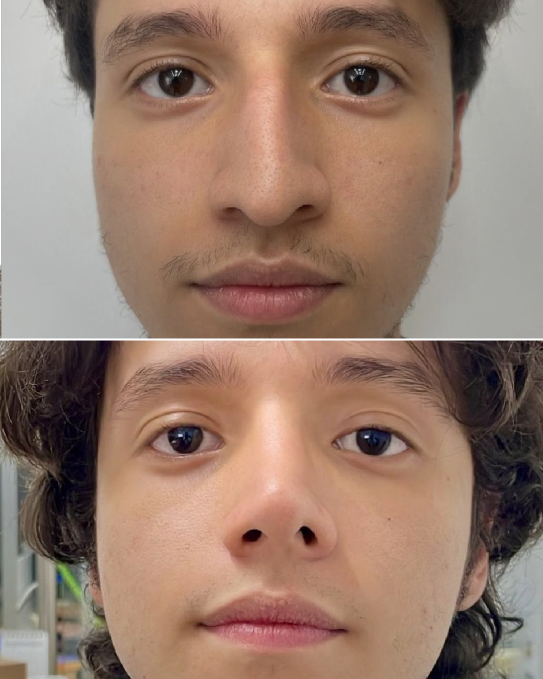Resultado de rinoplastia, caso real, antes y después