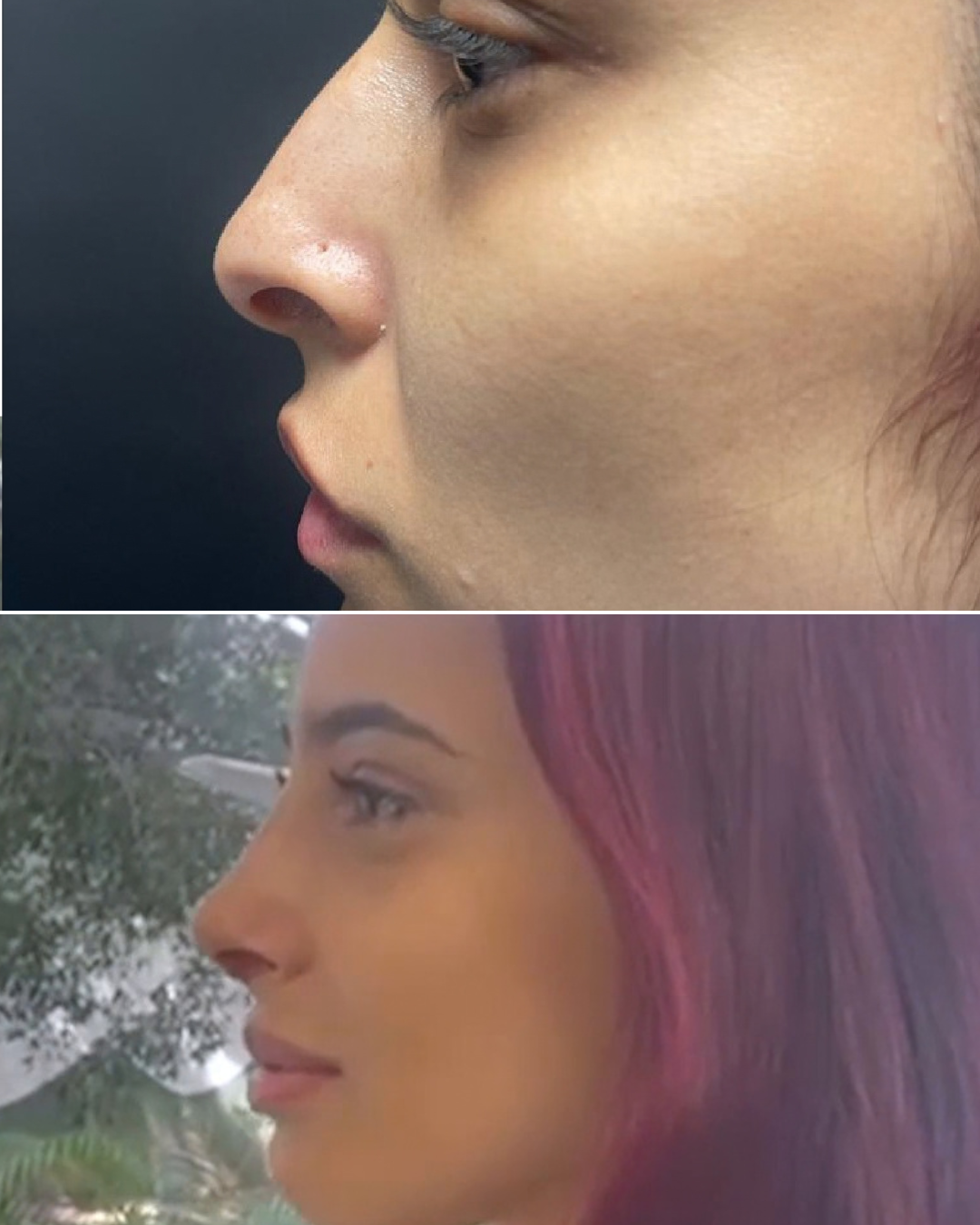 Resultado de rinoplastia, caso real, antes y después